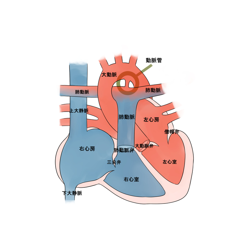 動脈管開存症の心臓